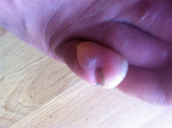 Poor little baby toe!